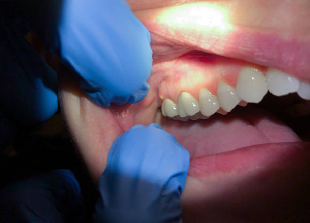Best Broken or Cracked Tooth Emergency Dentist in Palm Springs, CA